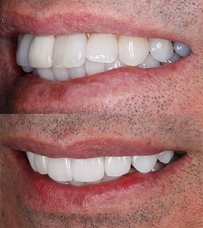 Before and after — Cosmetic & restorative dentistry — case 1 by Strupp & Brumm in Clearwater, FL