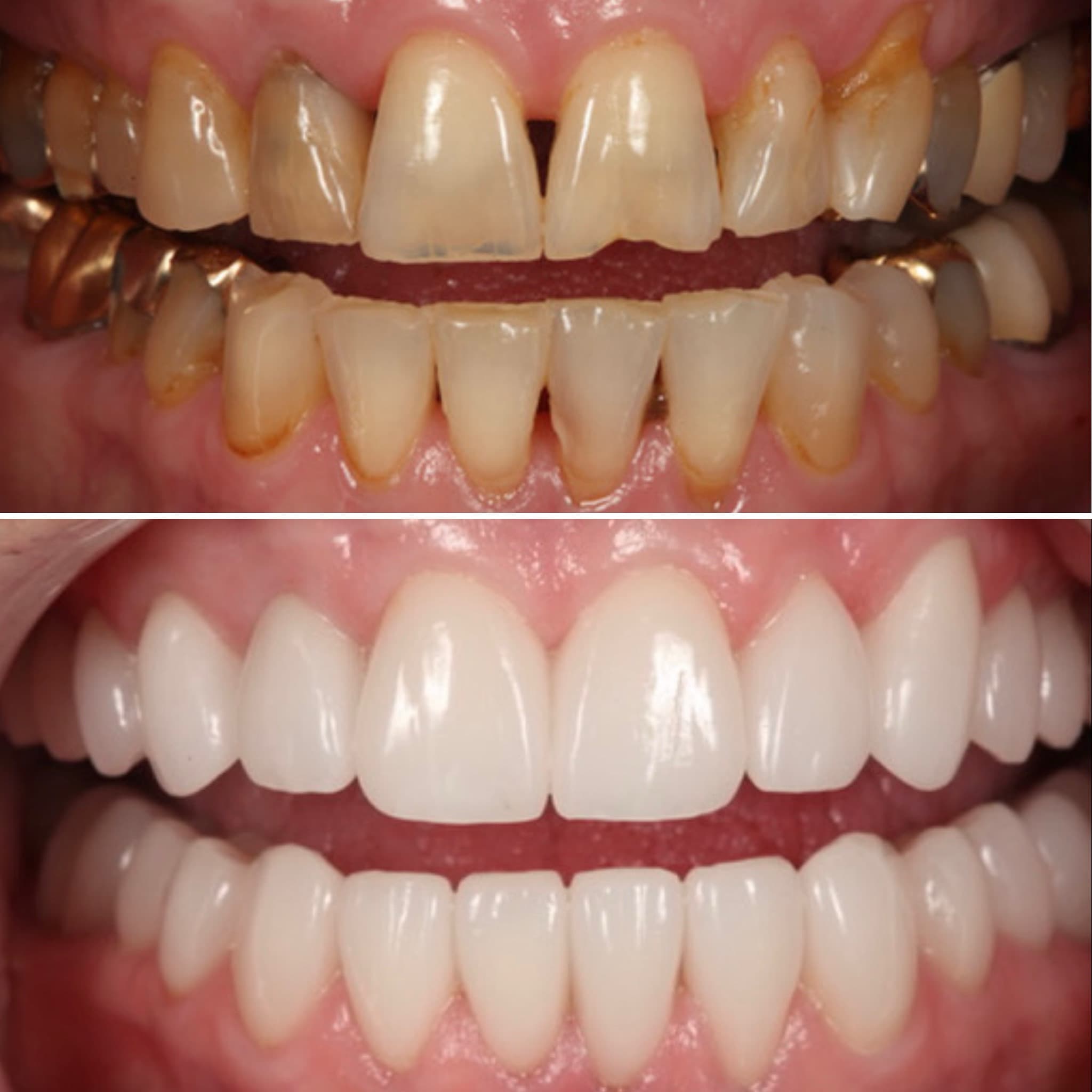 Before and after — Cosmetic & restorative dentistry — case 102 by Strupp & Brumm in Clearwater, FL