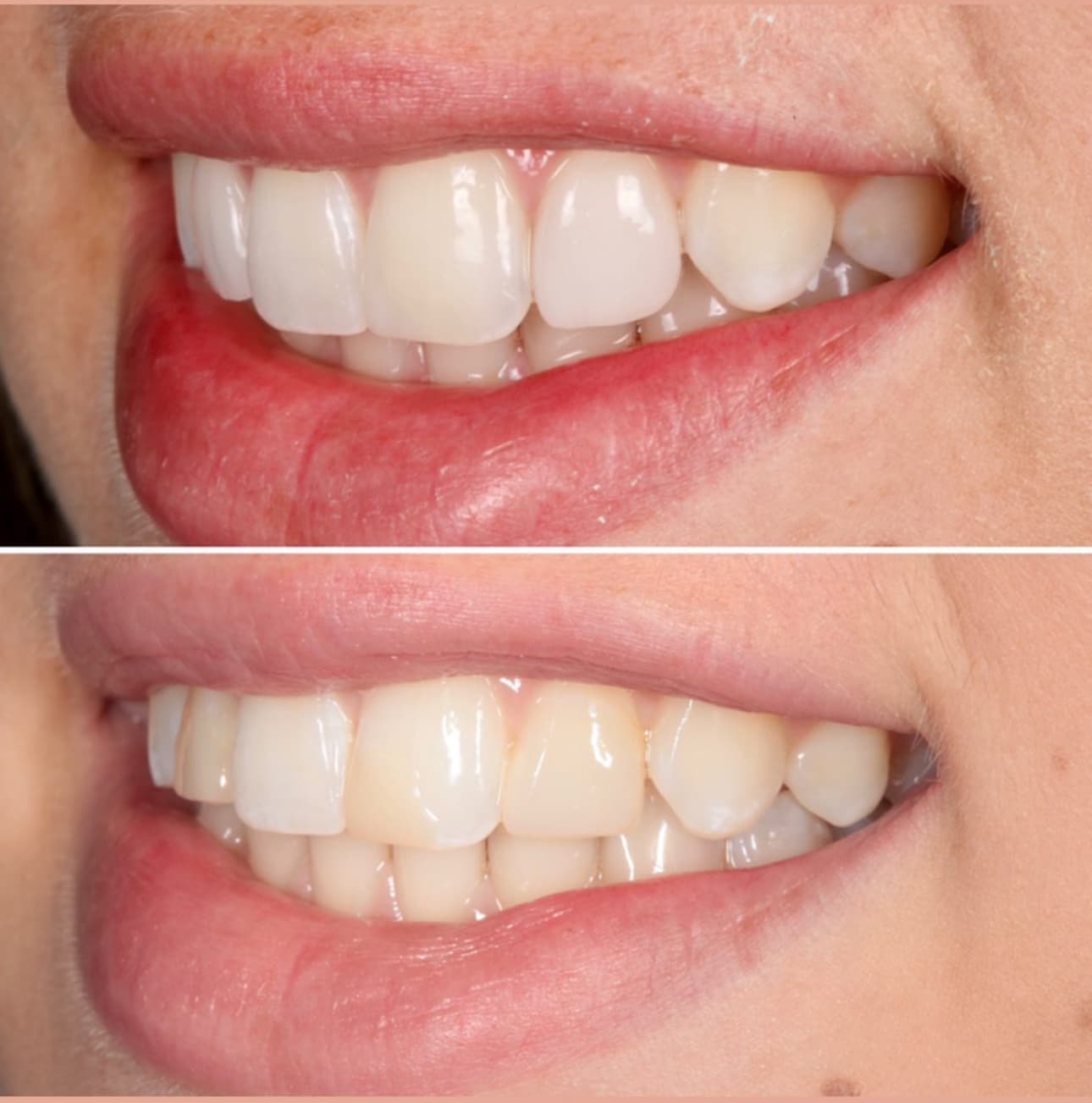 Before and after — Cosmetic & restorative dentistry — case 103 by Strupp & Brumm in Clearwater, FL