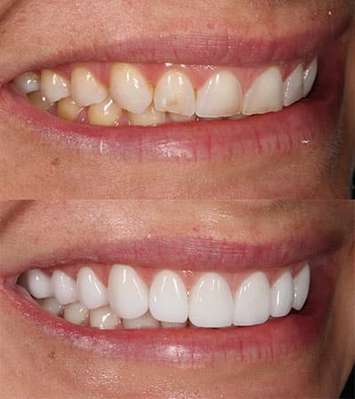 Before and after — Cosmetic & restorative dentistry — case 12 by Strupp & Brumm in Clearwater, FL