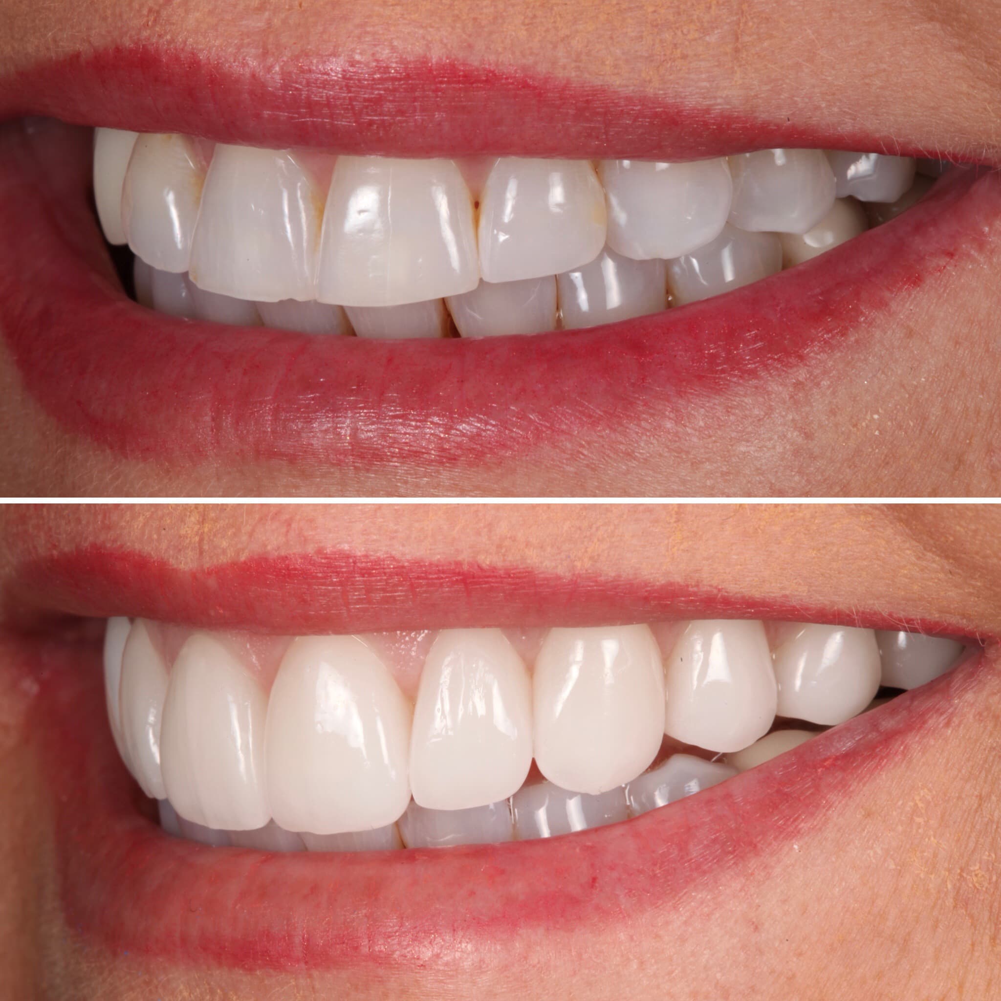 Before and after — Cosmetic & restorative dentistry — case 14 by Strupp & Brumm in Clearwater, FL