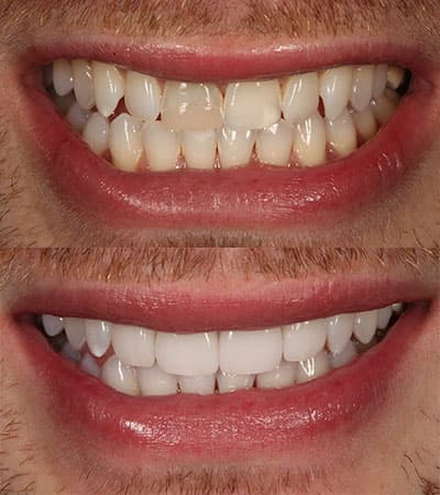 Before and after — Cosmetic & restorative dentistry — case 15 by Strupp & Brumm in Clearwater, FL