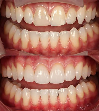 Before and after — Cosmetic & restorative dentistry — case 16 by Strupp & Brumm in Clearwater, FL