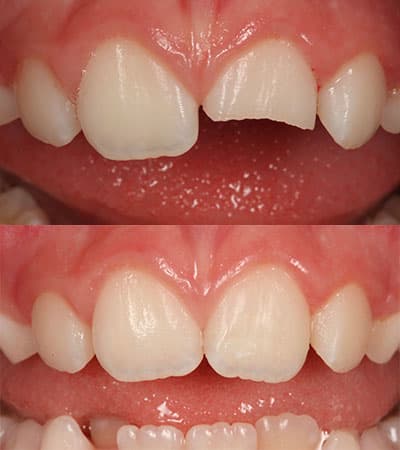 Before and after — Cosmetic & restorative dentistry — case 17 by Strupp & Brumm in Clearwater, FL