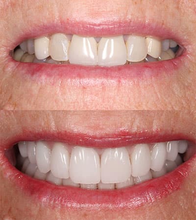 Before and after — Cosmetic & restorative dentistry — case 19 by Strupp & Brumm in Clearwater, FL
