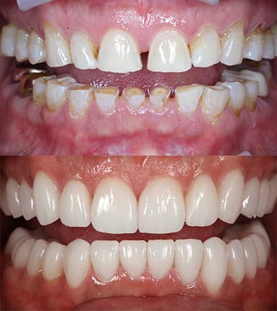 Before and after — Cosmetic & restorative dentistry — case 22 by Strupp & Brumm in Clearwater, FL