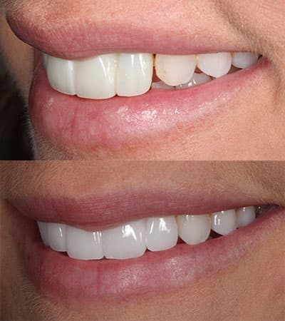 Before and after — Cosmetic & restorative dentistry — case 23 by Strupp & Brumm in Clearwater, FL