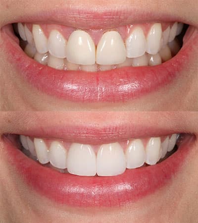 Before and after — Cosmetic & restorative dentistry — case 25 by Strupp & Brumm in Clearwater, FL