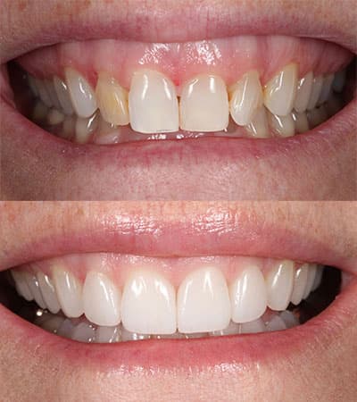 Before and after — Cosmetic & restorative dentistry — case 28 by Strupp & Brumm in Clearwater, FL