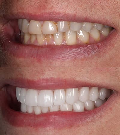 Before and after — Cosmetic & restorative dentistry — case 33 by Strupp & Brumm in Clearwater, FL