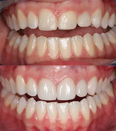 Before and after — Cosmetic & restorative dentistry — case 38 by Strupp & Brumm in Clearwater, FL