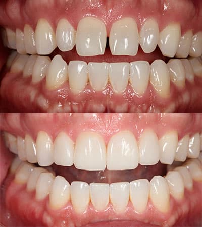 Before and after — Cosmetic & restorative dentistry — case 39 by Strupp & Brumm in Clearwater, FL