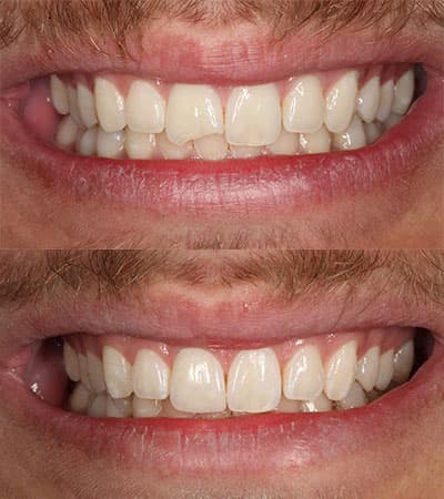Before and after — Cosmetic & restorative dentistry — case 41 by Strupp & Brumm in Clearwater, FL
