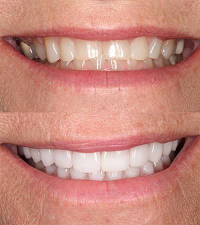 Before and after — Cosmetic & restorative dentistry — case 42 by Strupp & Brumm in Clearwater, FL