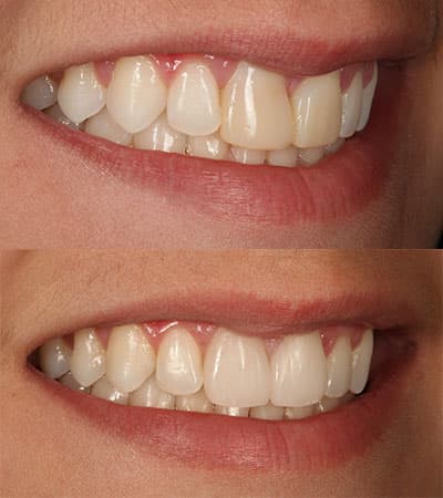 Before and after — Cosmetic & restorative dentistry — case 44 by Strupp & Brumm in Clearwater, FL