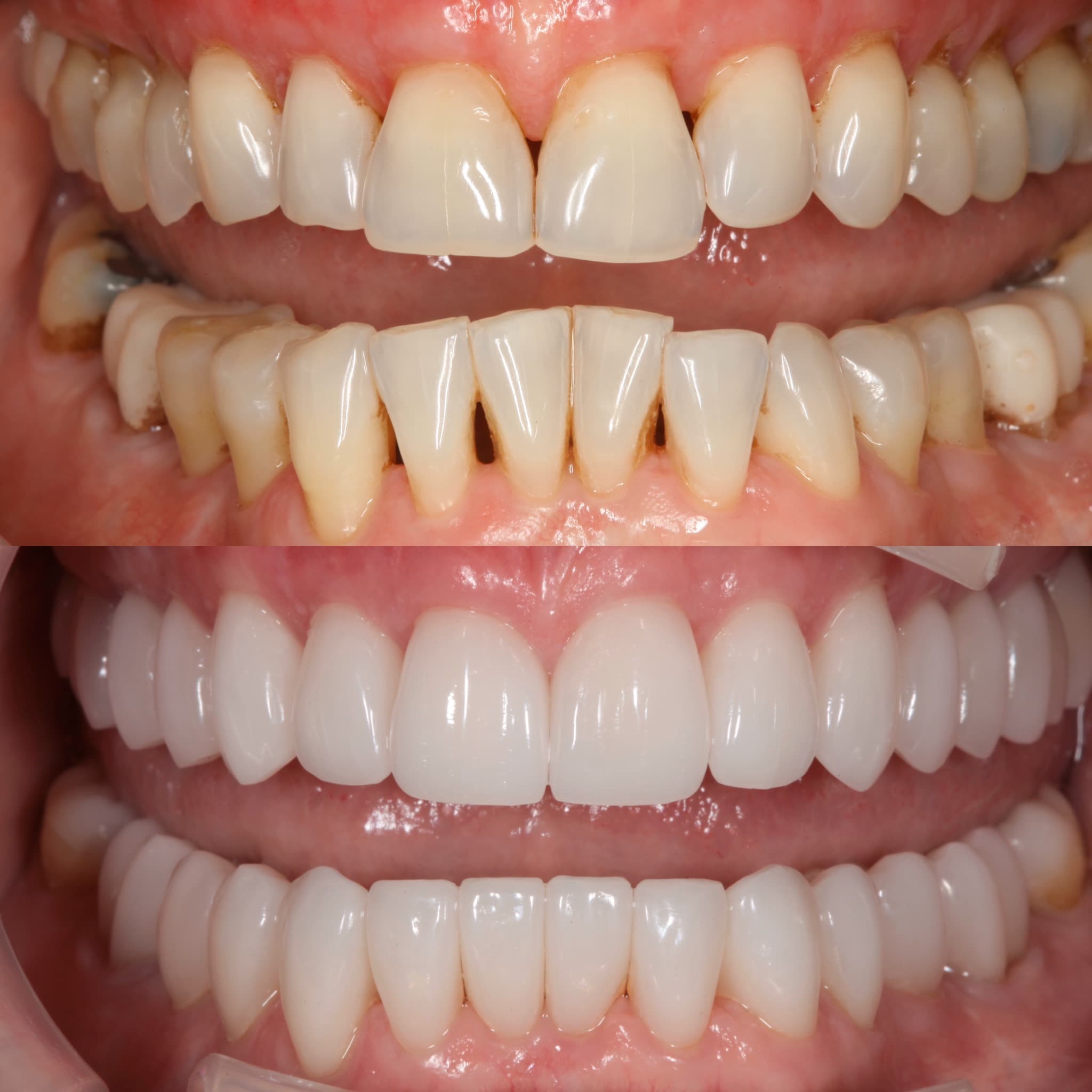 Before and after — Cosmetic & restorative dentistry — case 47 by Strupp & Brumm in Clearwater, FL
