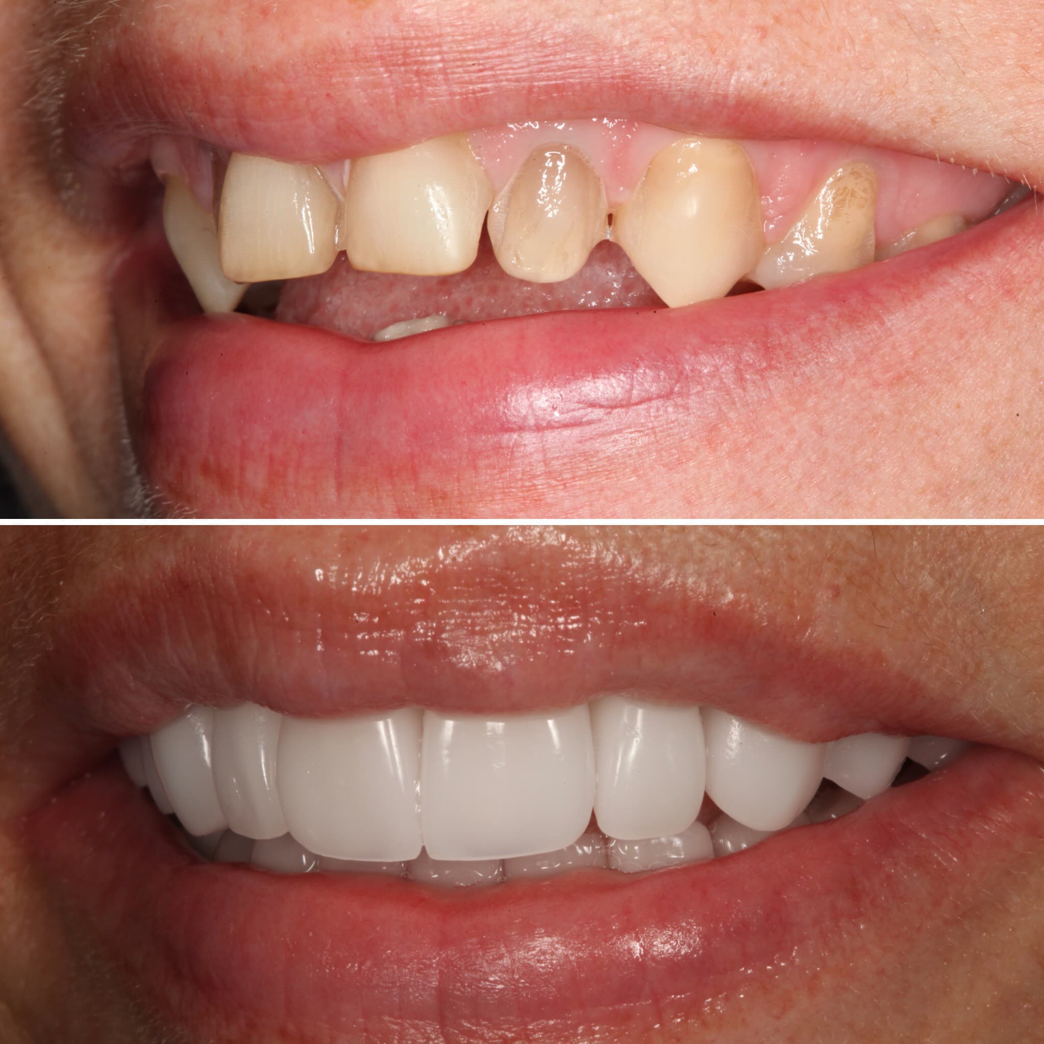 Before and after — Cosmetic & restorative dentistry — case 49 by Strupp & Brumm in Clearwater, FL