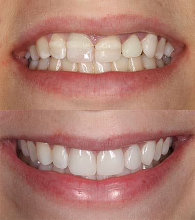 Before and after — Cosmetic & restorative dentistry — case 5 by Strupp & Brumm in Clearwater, FL