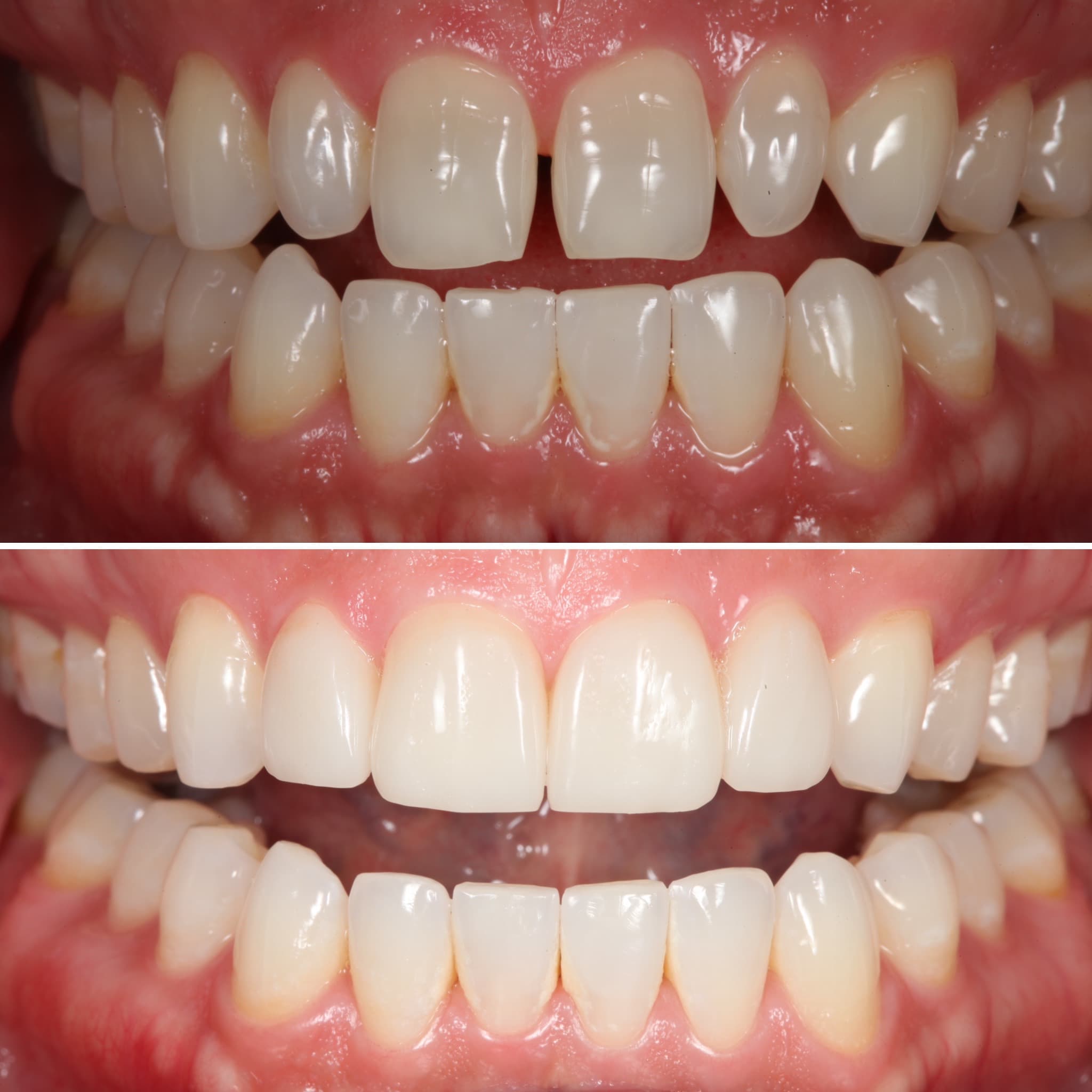 Before and after — Cosmetic & restorative dentistry — case 50 by Strupp & Brumm in Clearwater, FL