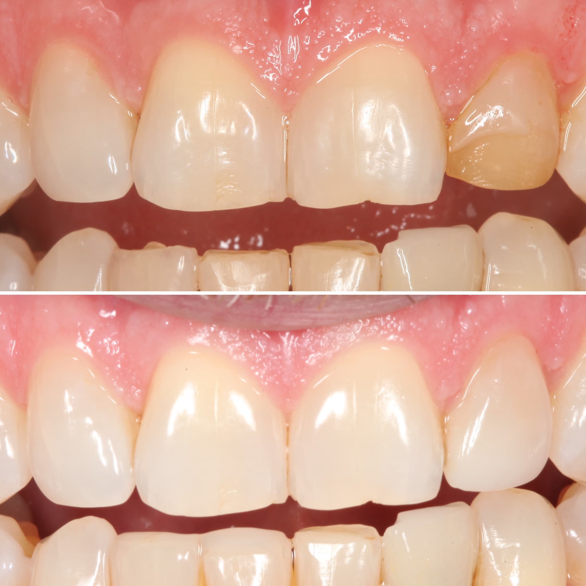 Before and after — Cosmetic & restorative dentistry — case 52 by Strupp & Brumm in Clearwater, FL