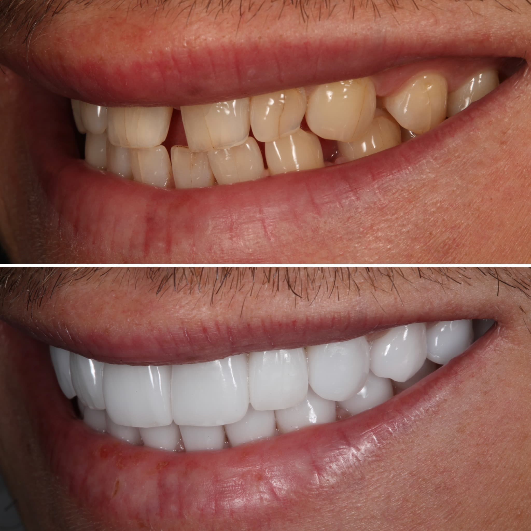Before and after — Cosmetic & restorative dentistry — case 64 by Strupp & Brumm in Clearwater, FL