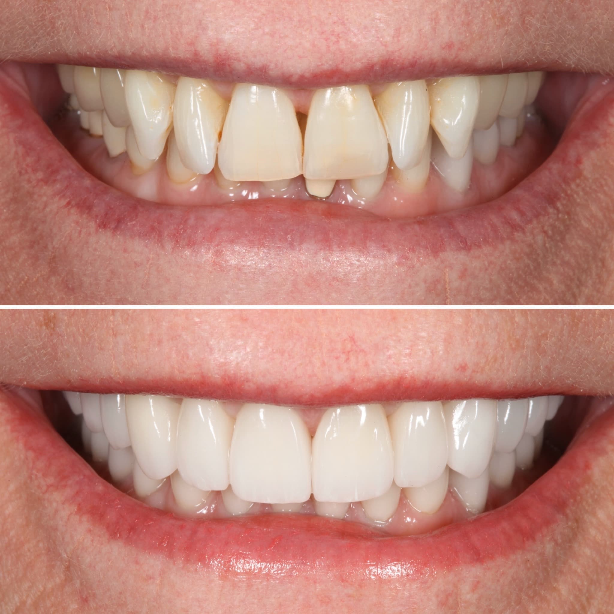Before and after — Cosmetic & restorative dentistry — case 69 by Strupp & Brumm in Clearwater, FL