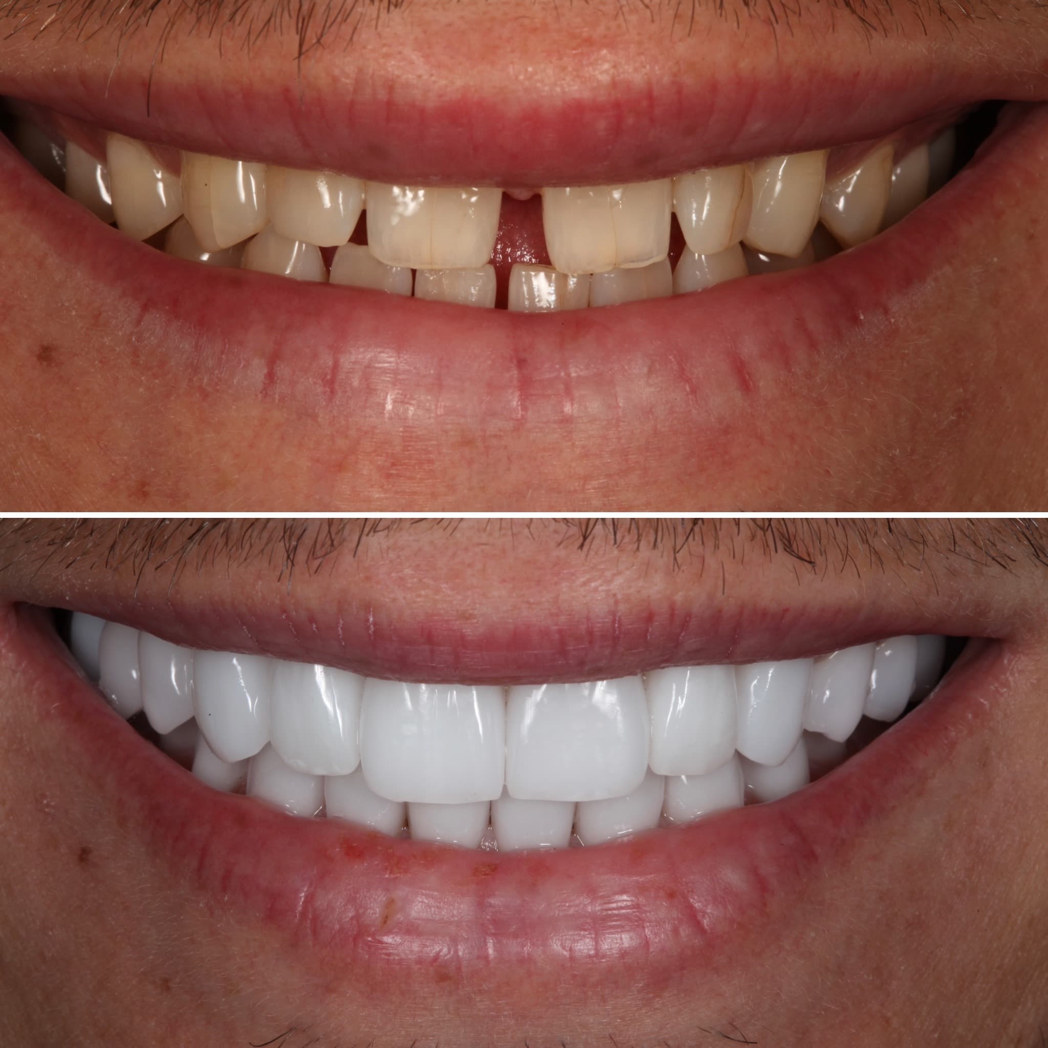 Before and after — Cosmetic & restorative dentistry — case 70 by Strupp & Brumm in Clearwater, FL