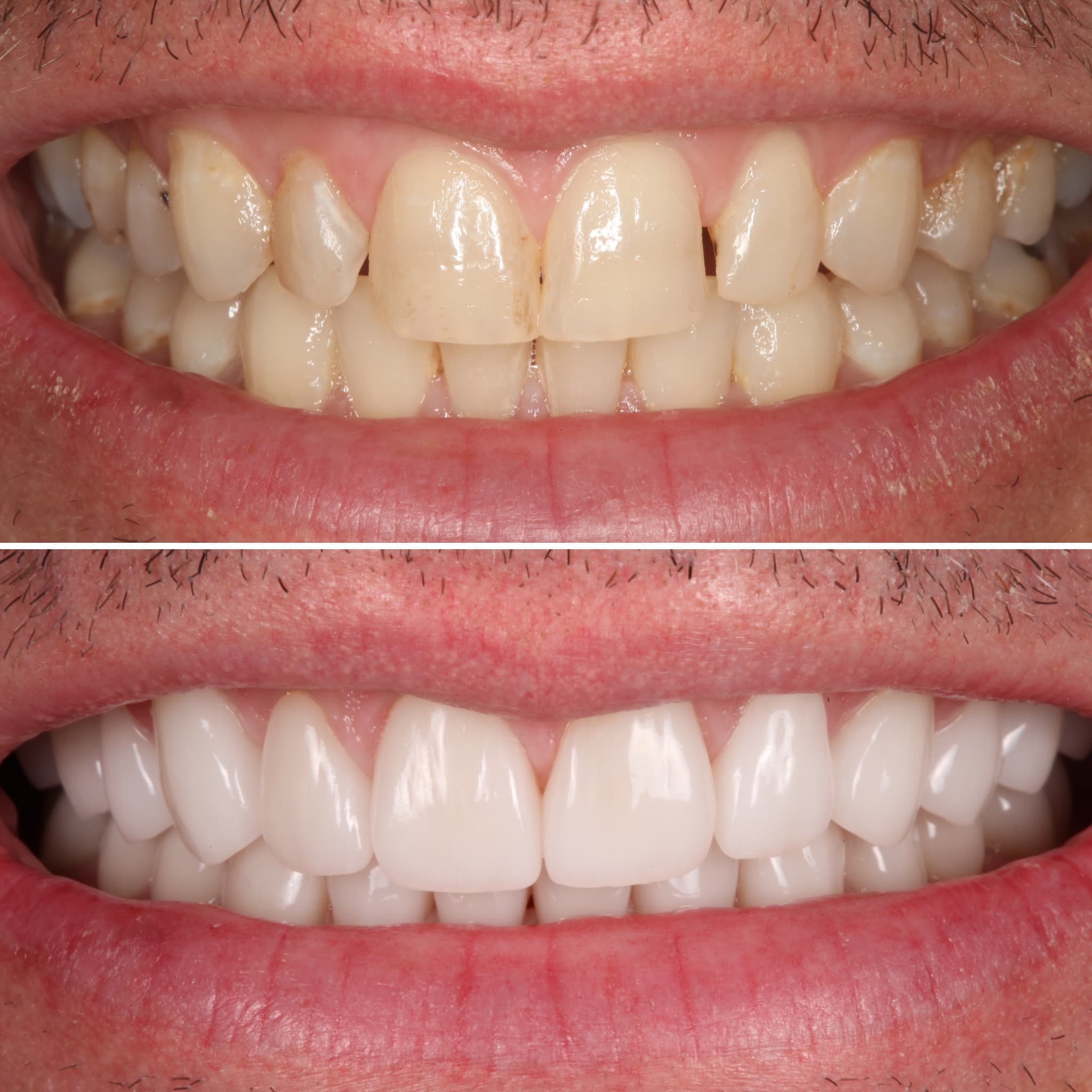 Before and after — Cosmetic & restorative dentistry — case 71 by Strupp & Brumm in Clearwater, FL