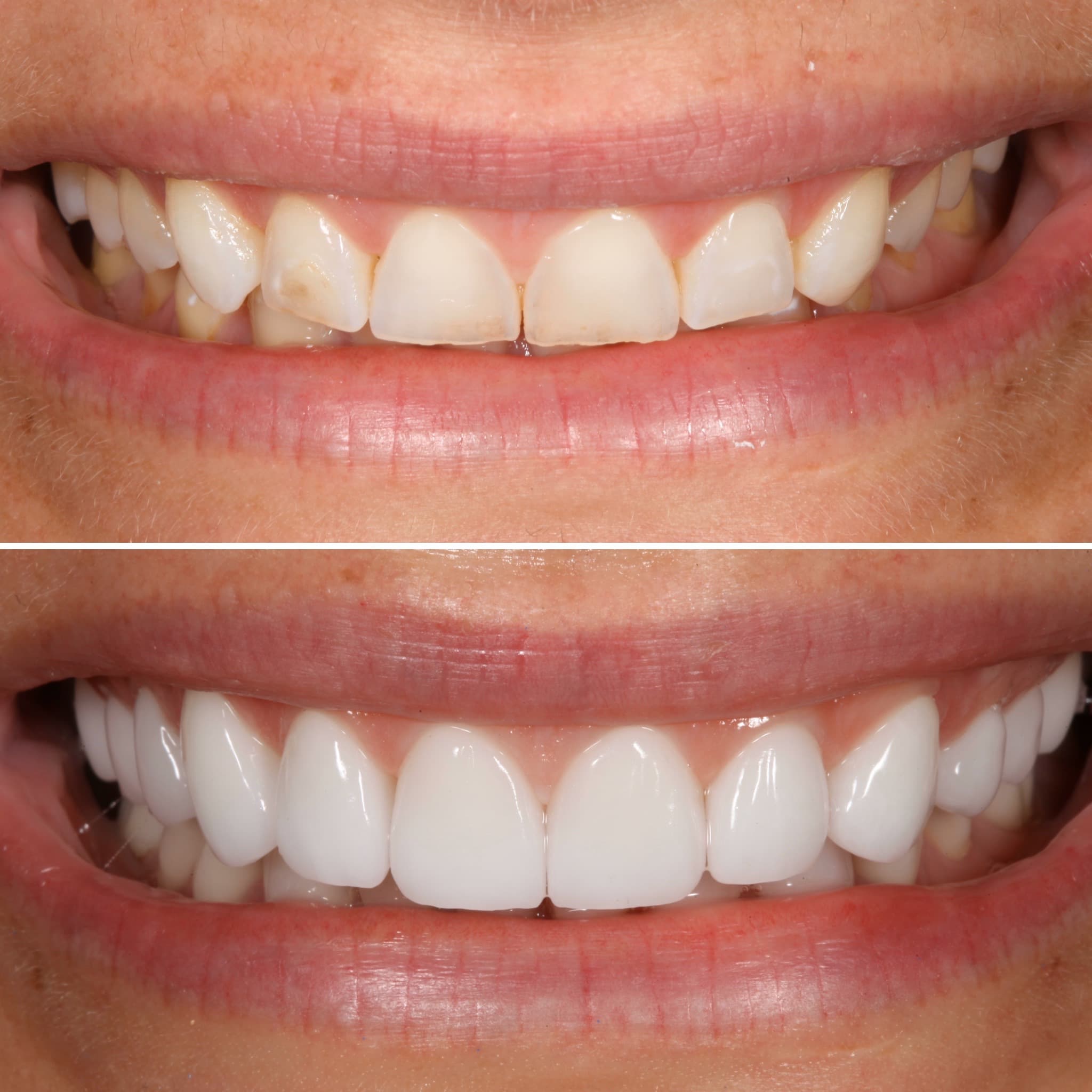 Before and after — Cosmetic & restorative dentistry — case 74 by Strupp & Brumm in Clearwater, FL
