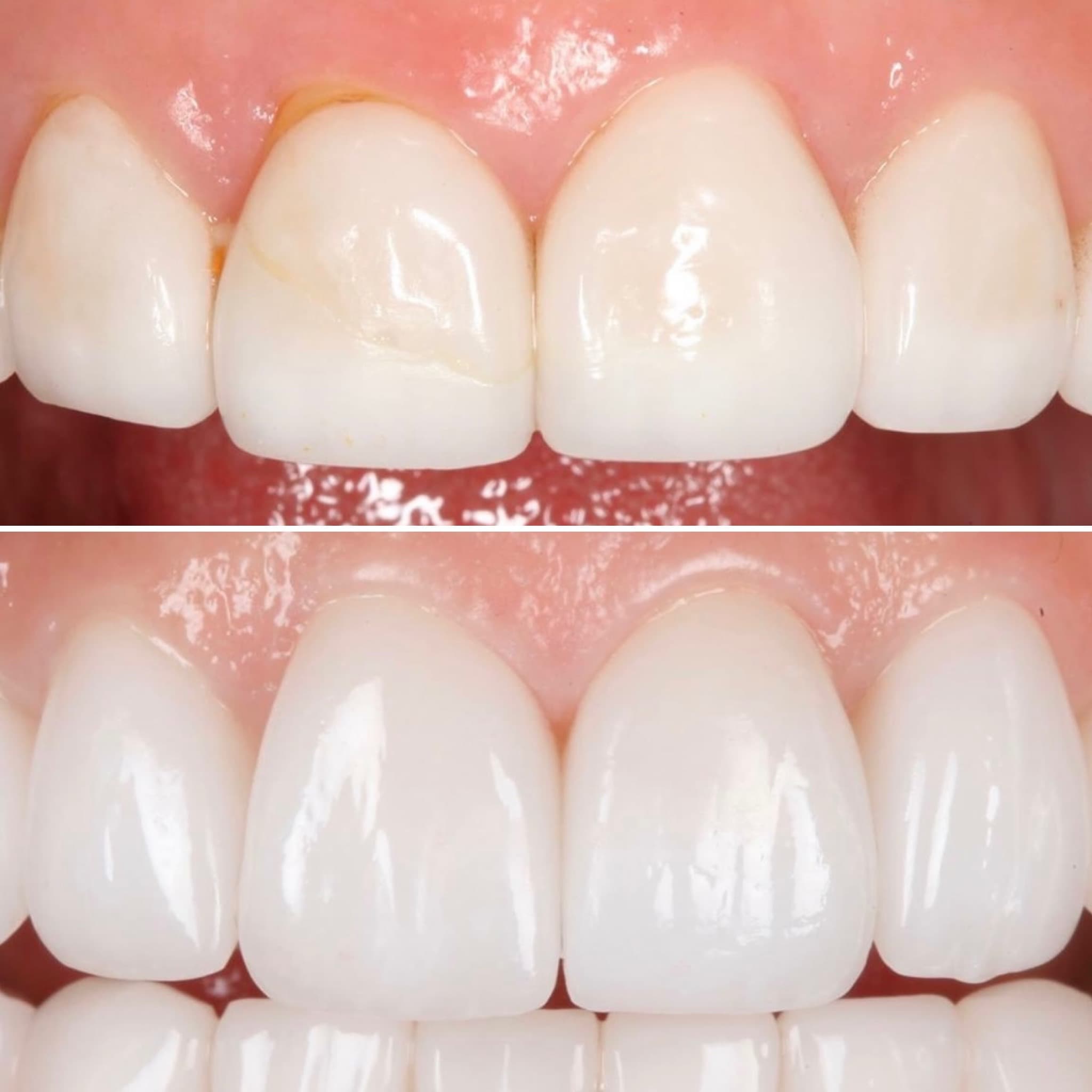 Before and after — Cosmetic & restorative dentistry — case 76 by Strupp & Brumm in Clearwater, FL