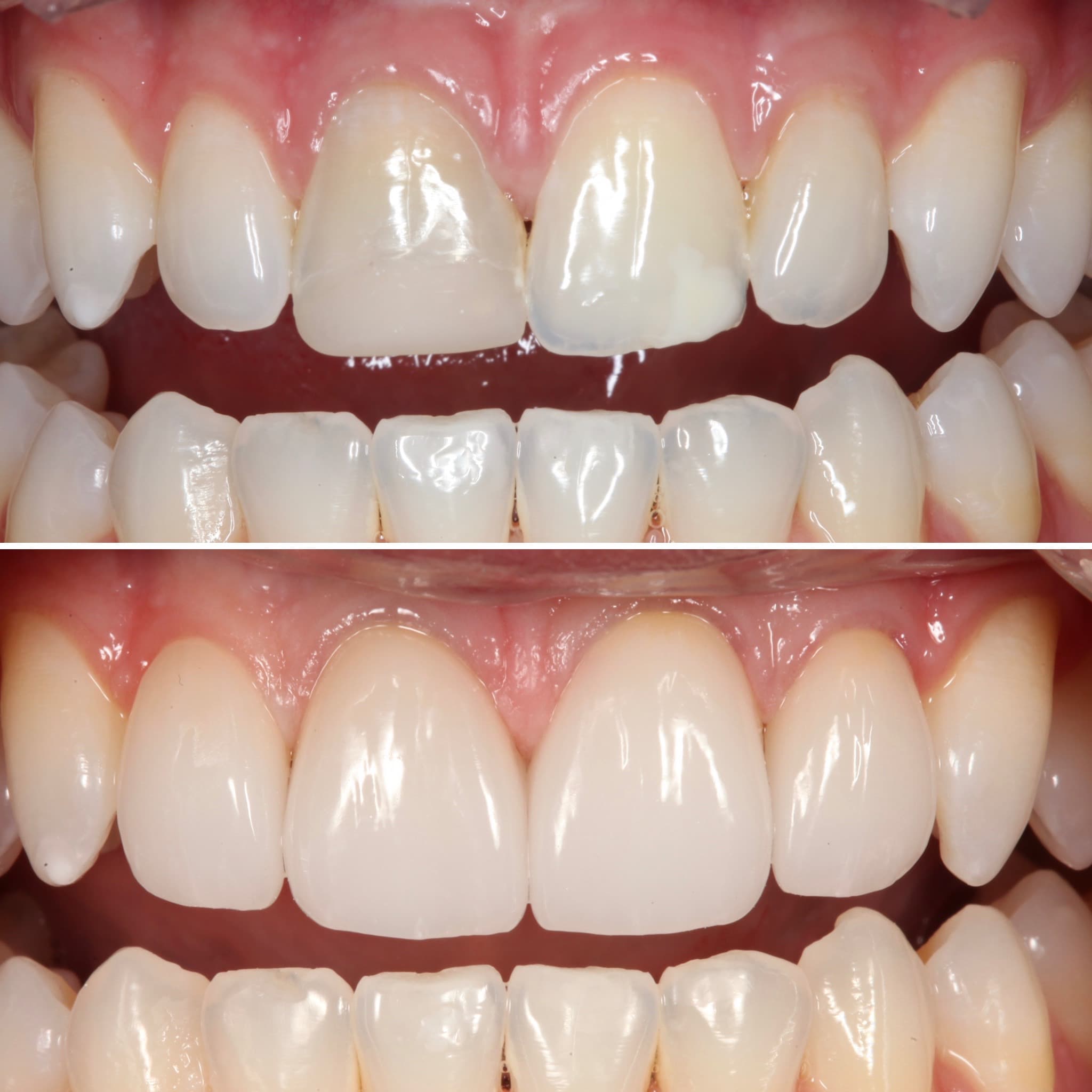 Before and after — Cosmetic & restorative dentistry — case 79 by Strupp & Brumm in Clearwater, FL