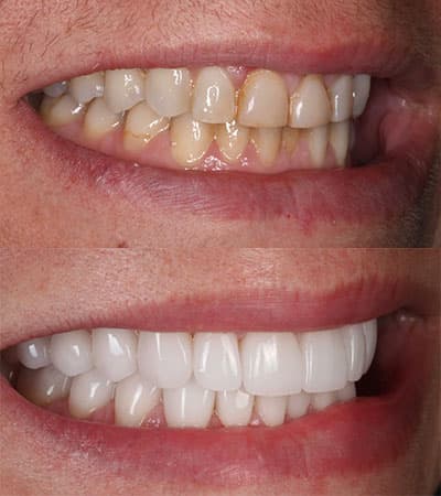 Before and after — Cosmetic & restorative dentistry — case 8 by Strupp & Brumm in Clearwater, FL