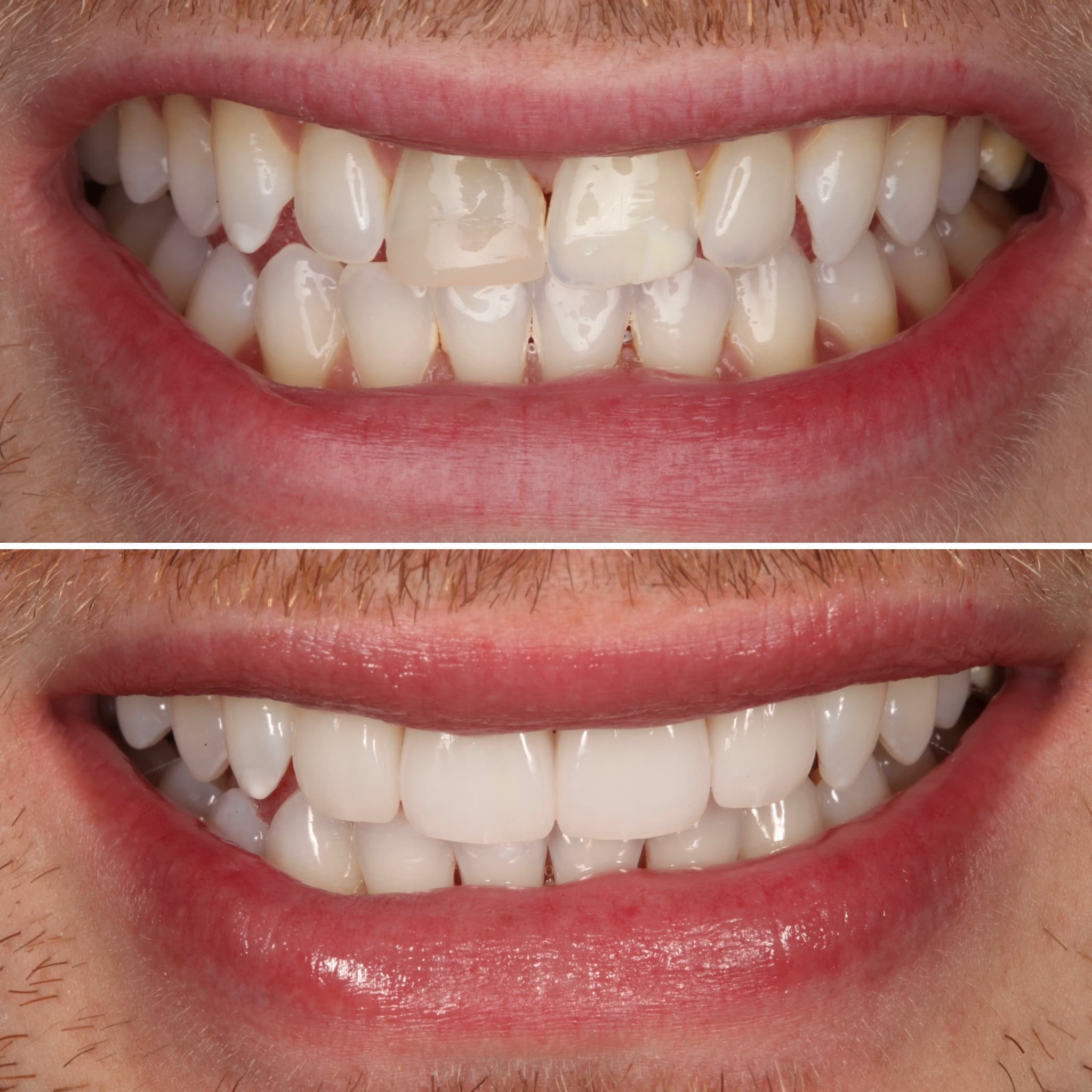 Before and after — Cosmetic & restorative dentistry — case 81 by Strupp & Brumm in Clearwater, FL