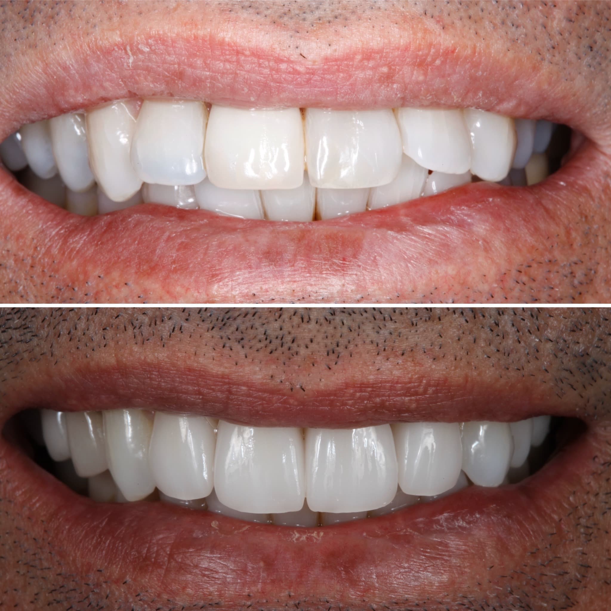 Before and after — Cosmetic & restorative dentistry — case 82 by Strupp & Brumm in Clearwater, FL