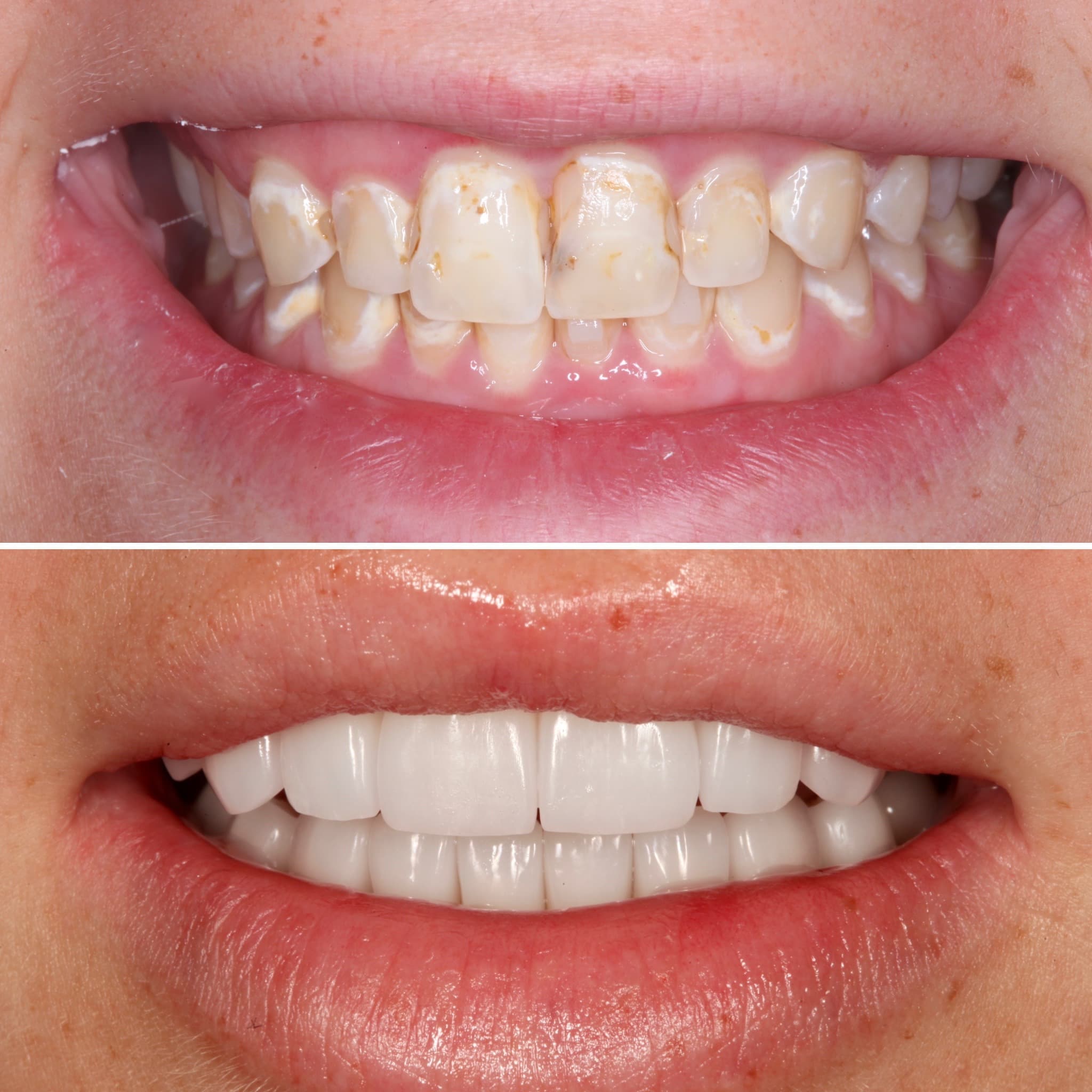 Before and after — Cosmetic & restorative dentistry — case 83 by Strupp & Brumm in Clearwater, FL
