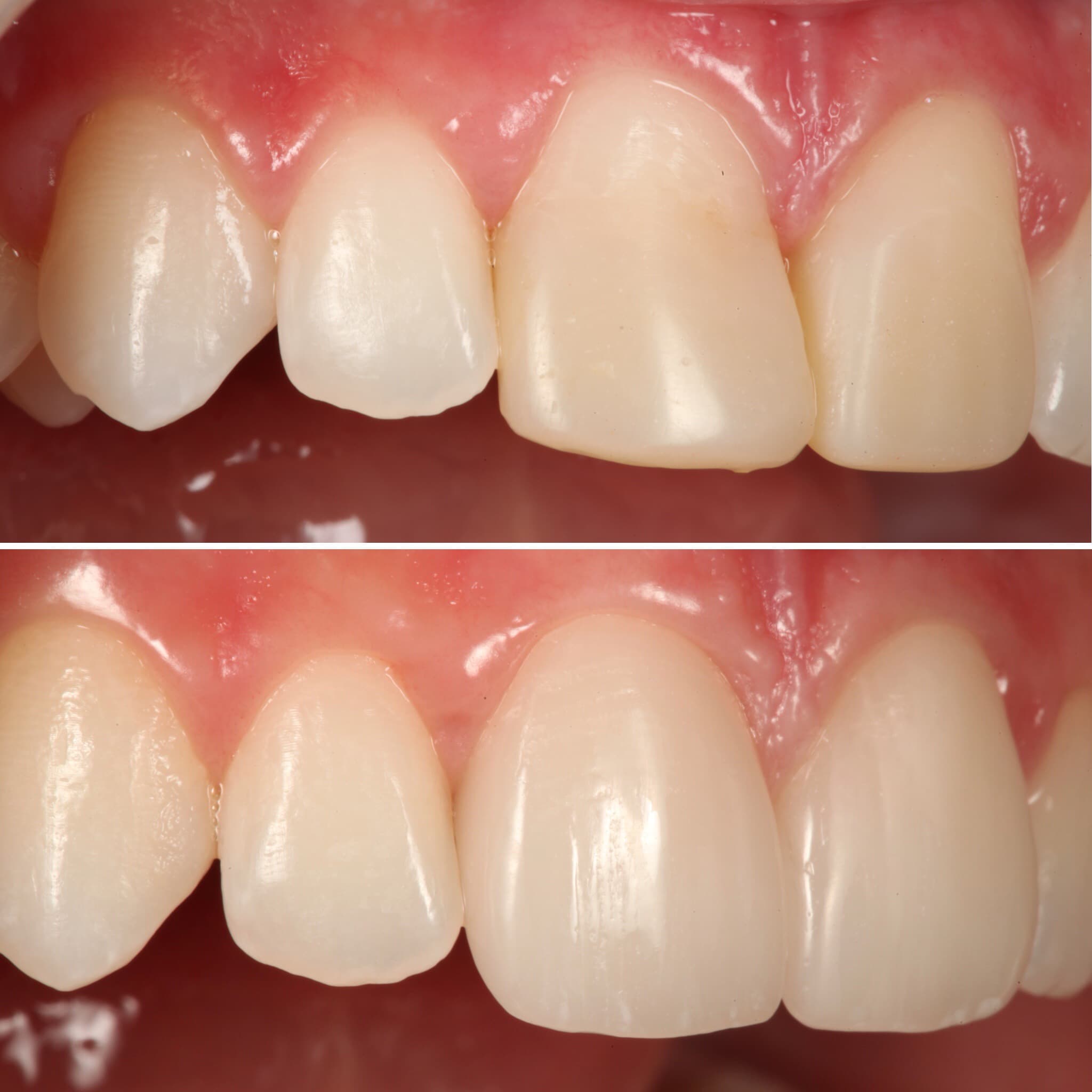 Before and after — Cosmetic & restorative dentistry — case 84 by Strupp & Brumm in Clearwater, FL