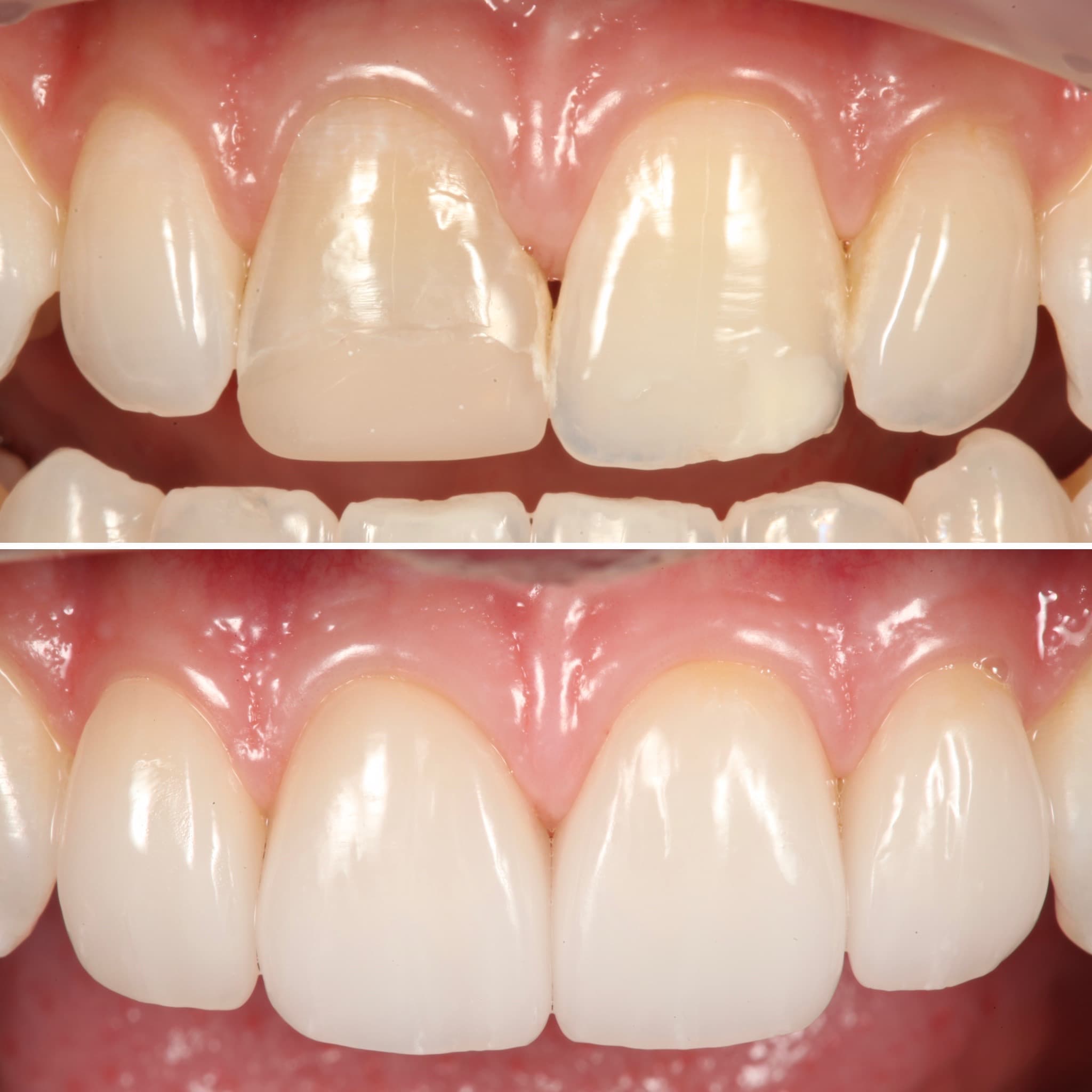 Before and after — Cosmetic & restorative dentistry — case 85 by Strupp & Brumm in Clearwater, FL