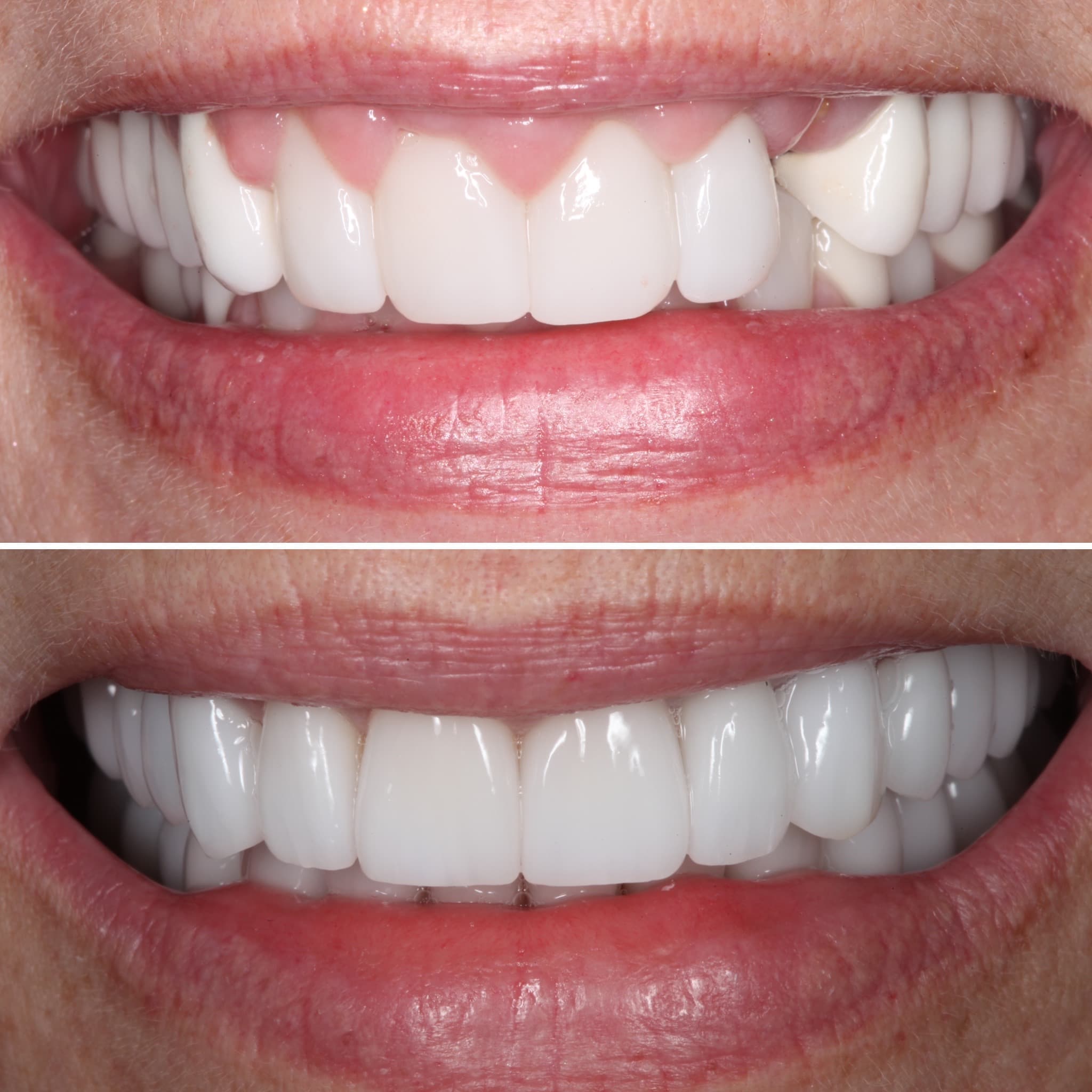 Before and after — Cosmetic & restorative dentistry — case 86 by Strupp & Brumm in Clearwater, FL