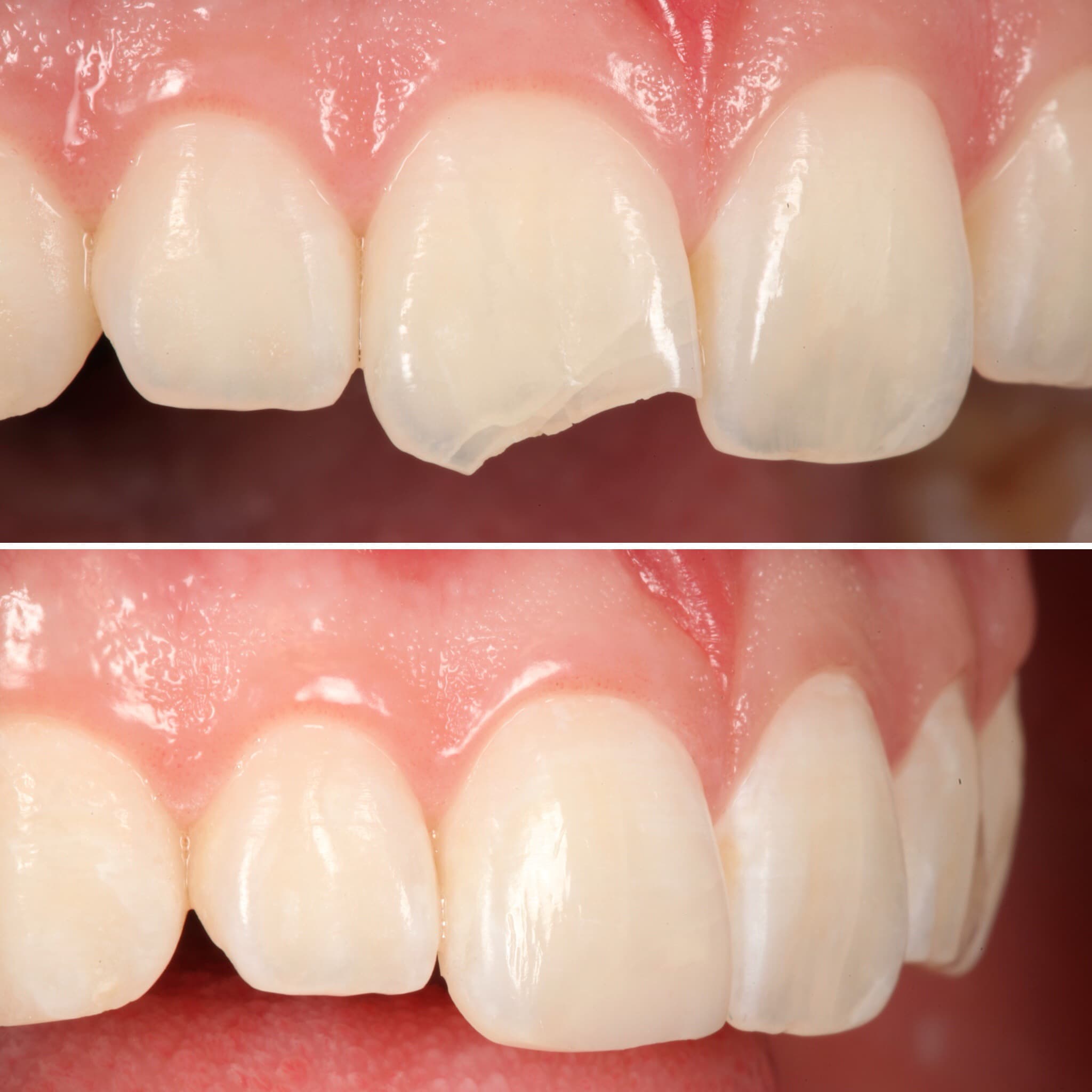 Before and after — Cosmetic & restorative dentistry — case 87 by Strupp & Brumm in Clearwater, FL