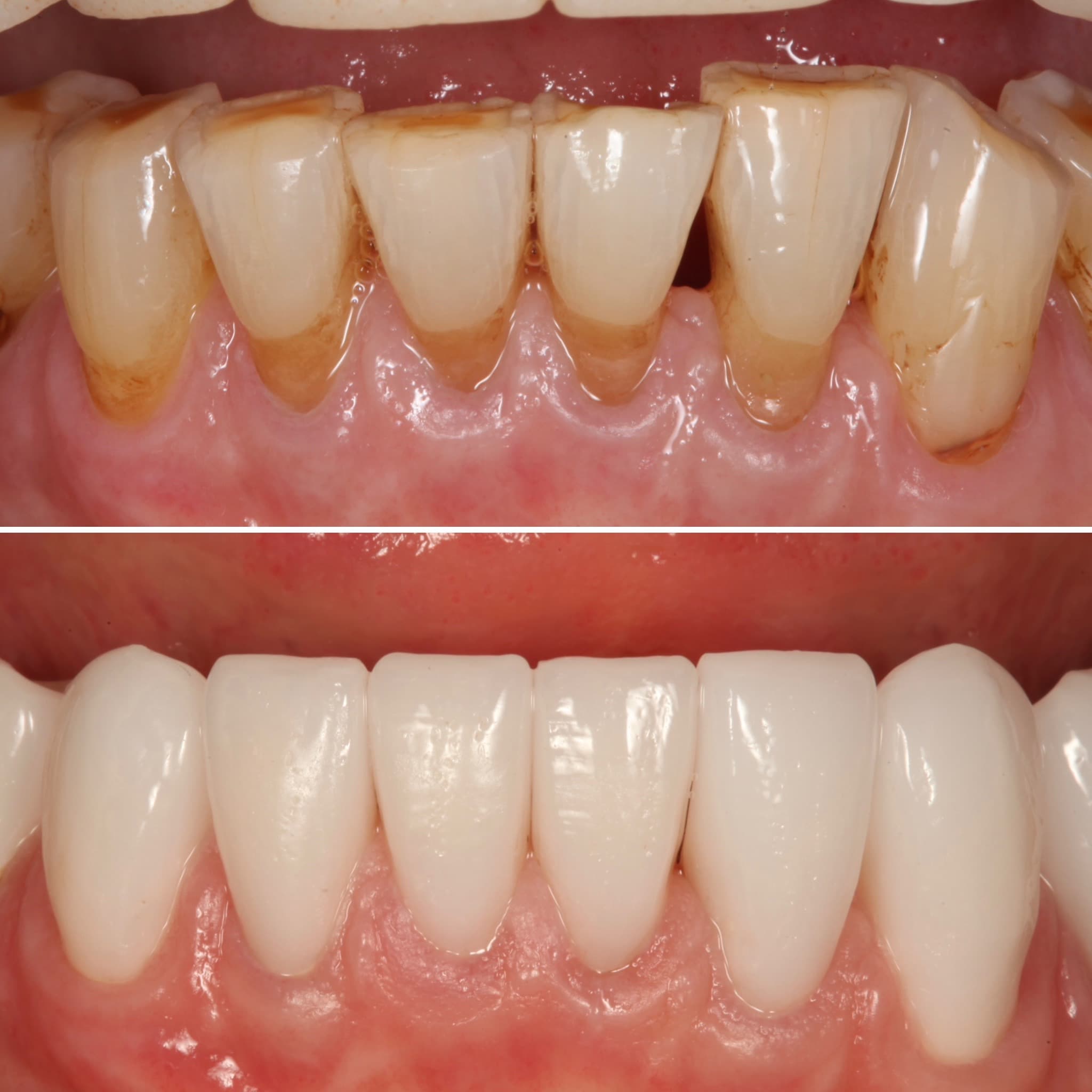 Before and after — Cosmetic & restorative dentistry — case 88 by Strupp & Brumm in Clearwater, FL