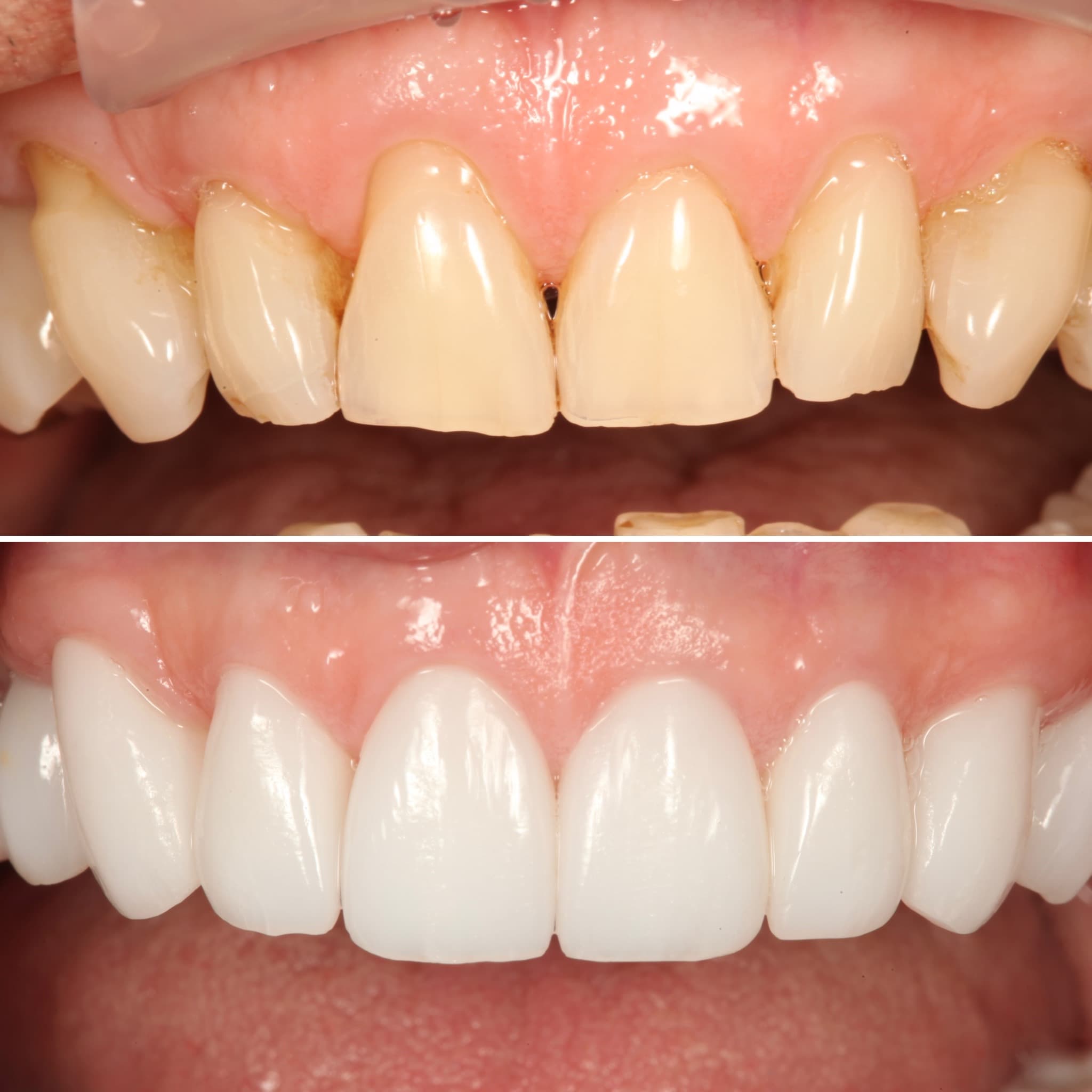 Before and after — Cosmetic & restorative dentistry — case 89 by Strupp & Brumm in Clearwater, FL