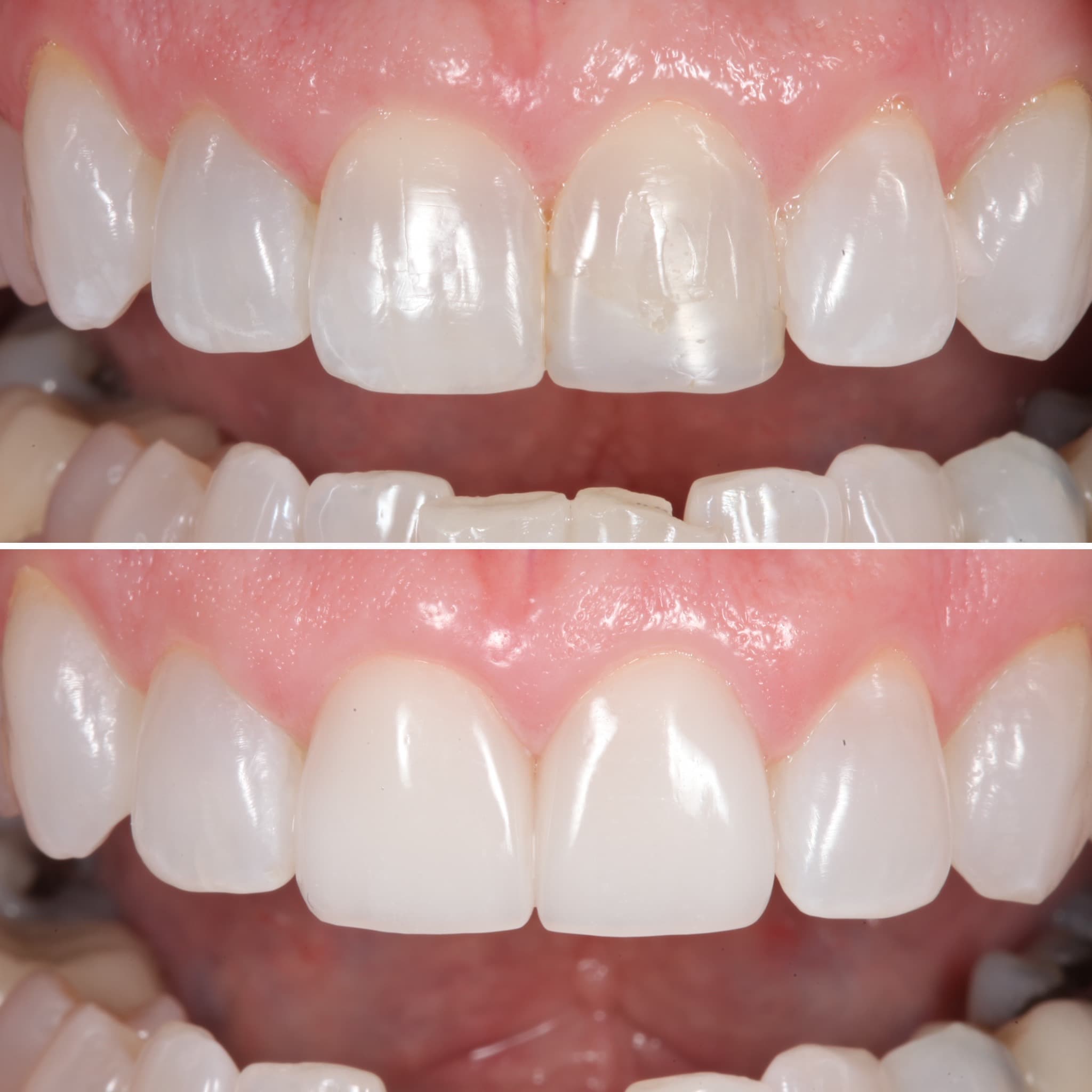Before and after — Cosmetic & restorative dentistry — case 90 by Strupp & Brumm in Clearwater, FL