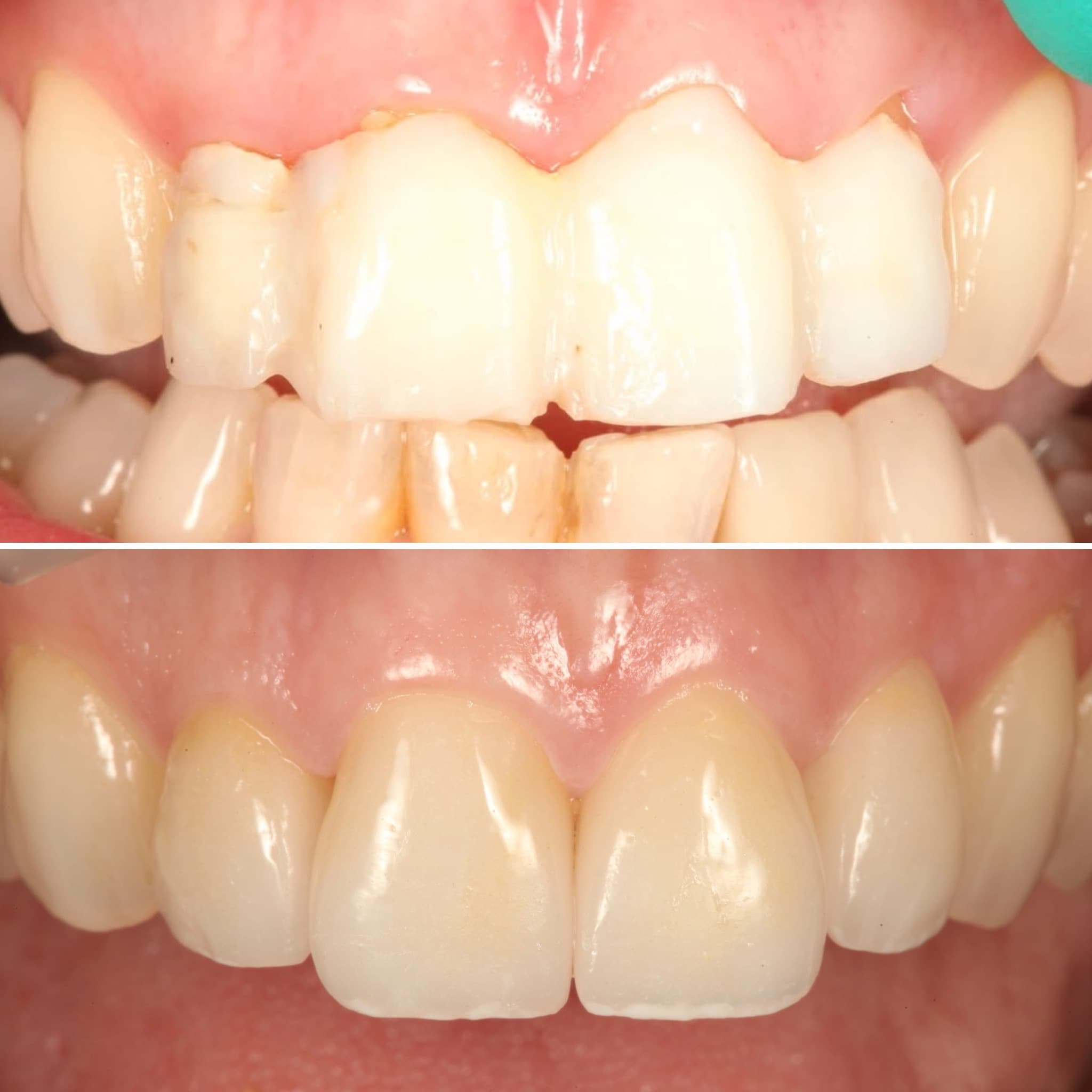 Before and after — Cosmetic & restorative dentistry — case 91 by Strupp & Brumm in Clearwater, FL