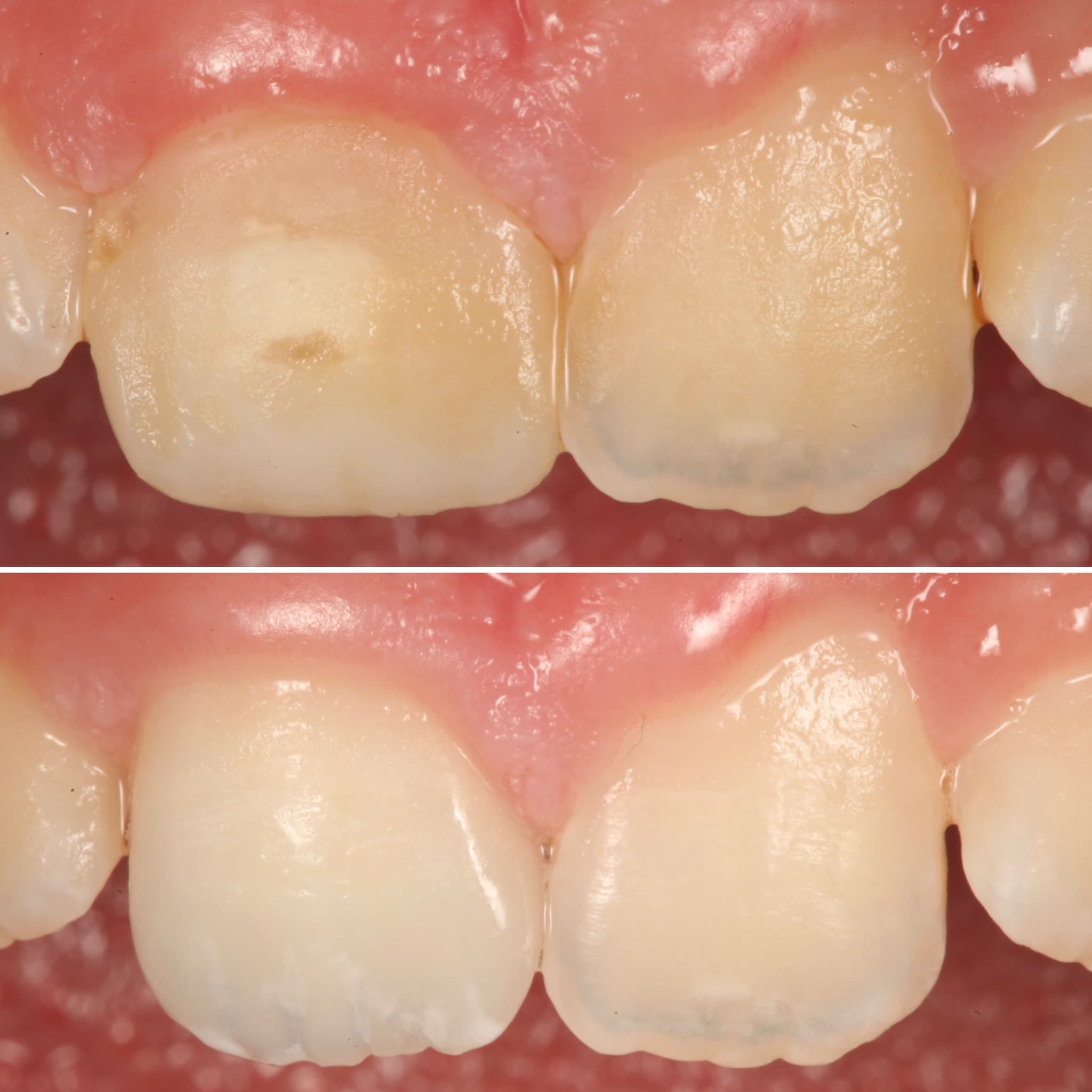 Before and after — Cosmetic & restorative dentistry — case 92 by Strupp & Brumm in Clearwater, FL