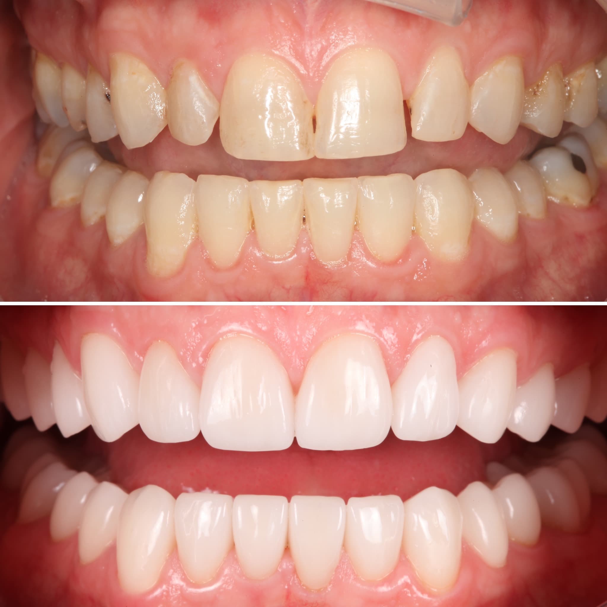 Before and after — Cosmetic & restorative dentistry — case 93 by Strupp & Brumm in Clearwater, FL
