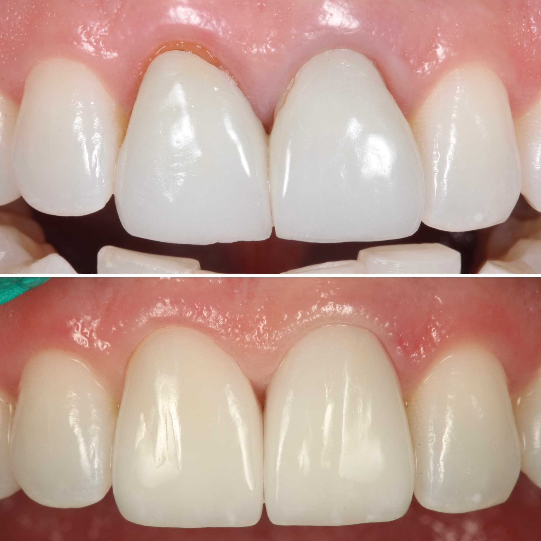 Before and after — Cosmetic & restorative dentistry — case 95 by Strupp & Brumm in Clearwater, FL