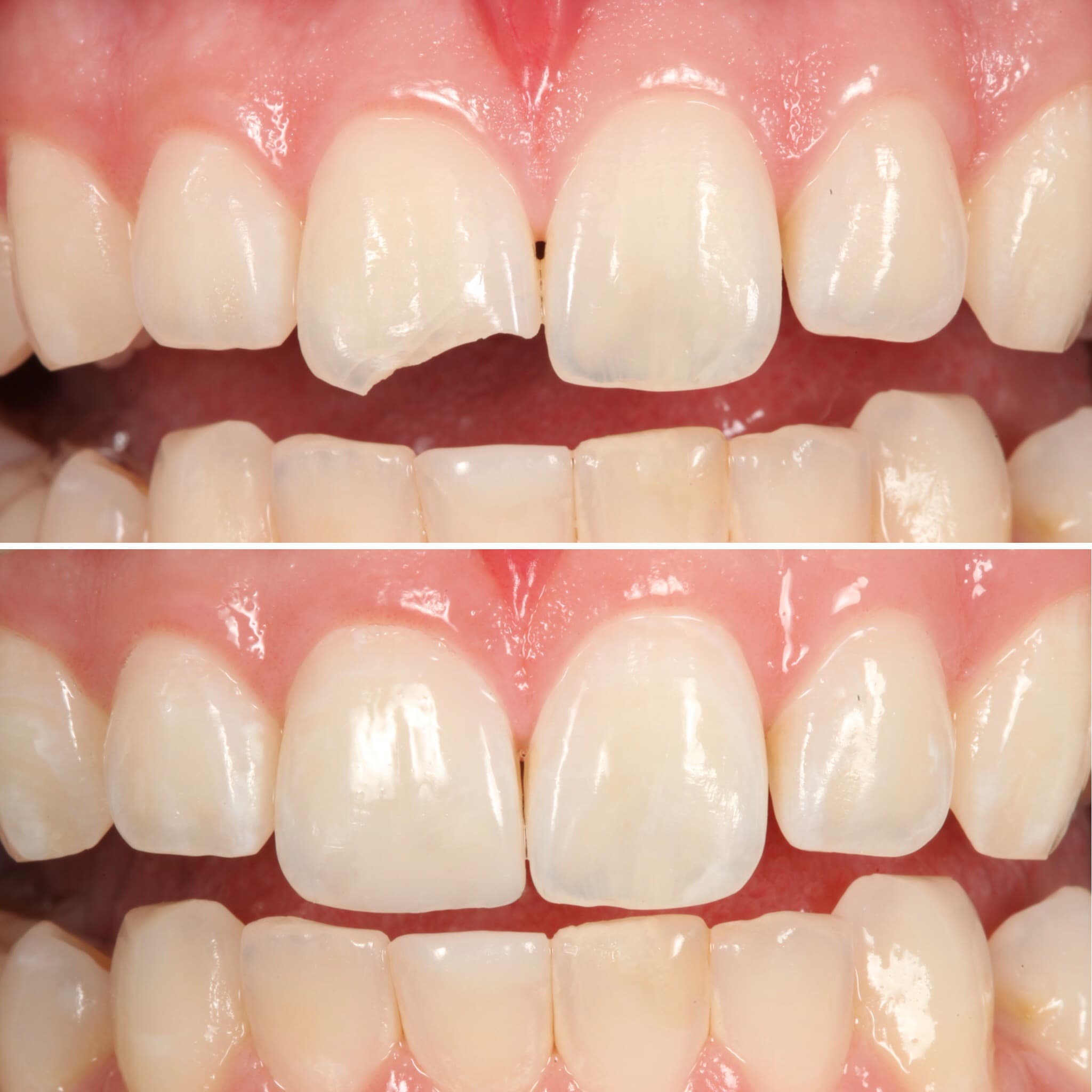 Before and after — Cosmetic & restorative dentistry — case 96 by Strupp & Brumm in Clearwater, FL