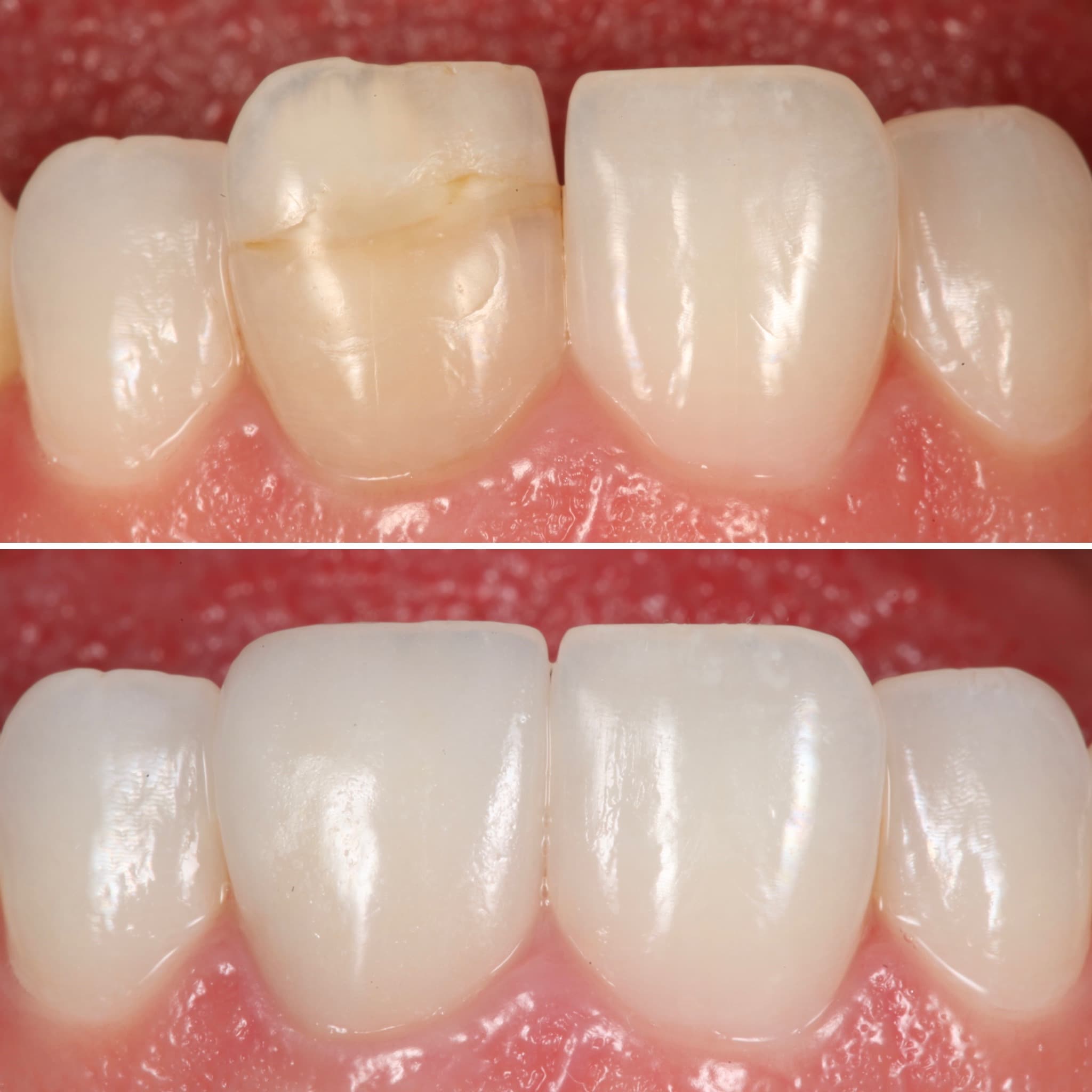 Before and after — Cosmetic & restorative dentistry — case 97 by Strupp & Brumm in Clearwater, FL