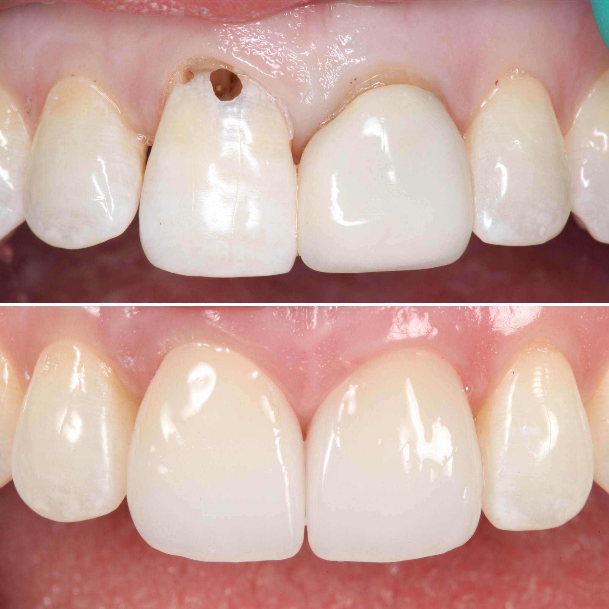 Cosmetic restoration by Strupp & Brumm — before and after, Clearwater, FL