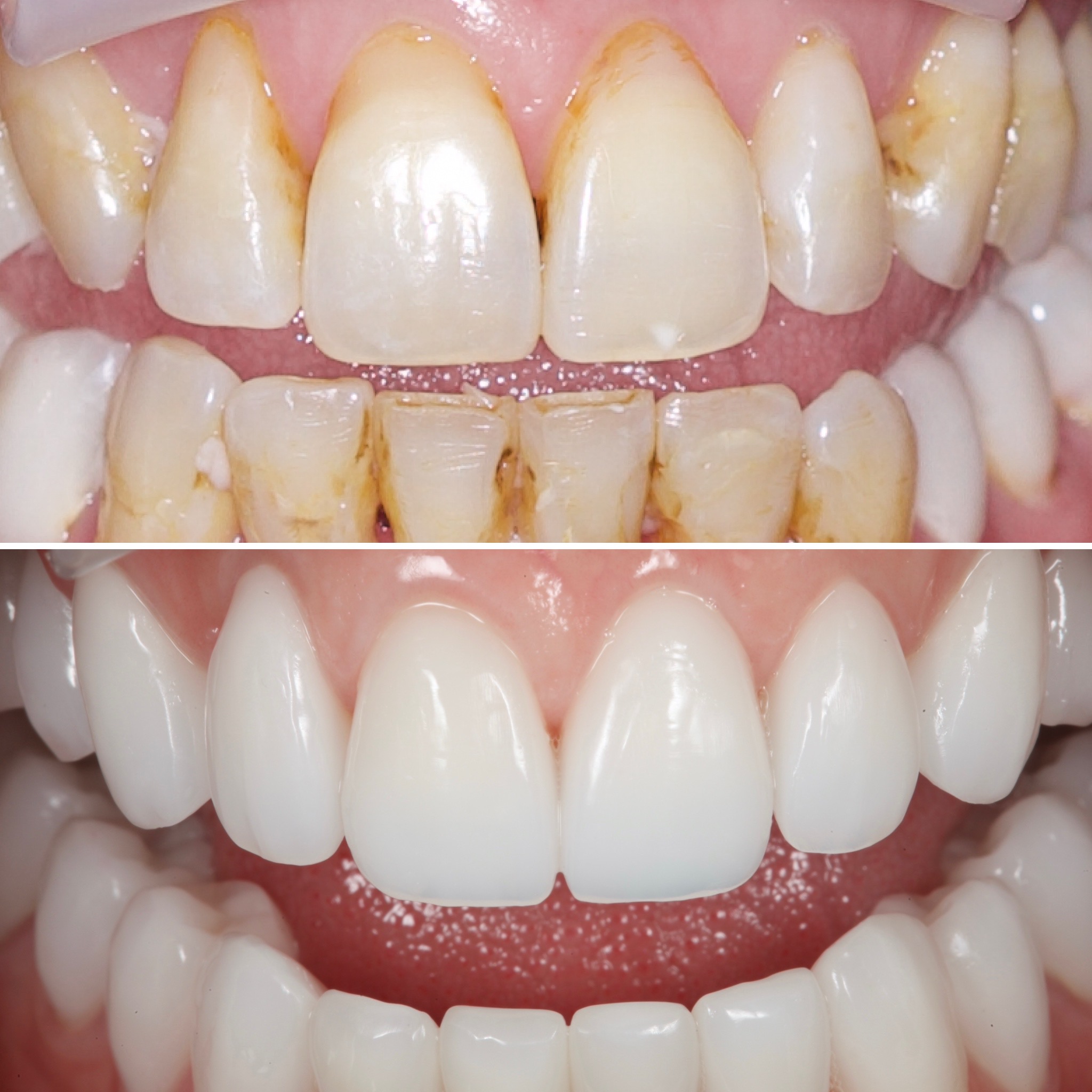 Porcelain veneer case — Strupp & Brumm cosmetic dentistry, Clearwater FL